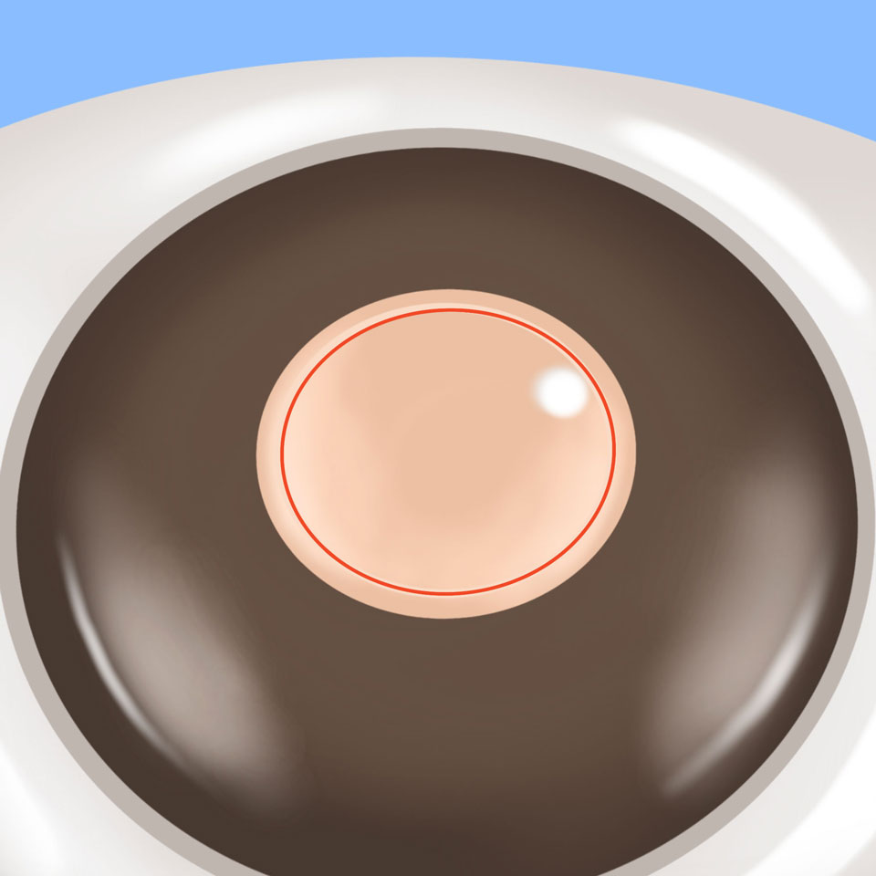 cataract_feature