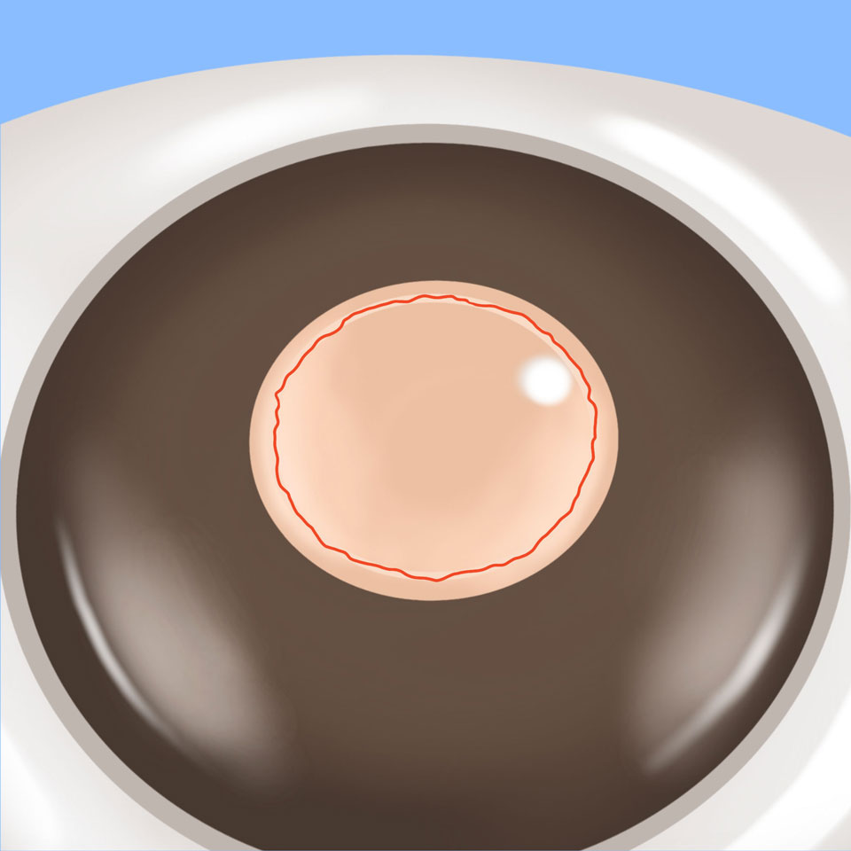 cataract_feature
