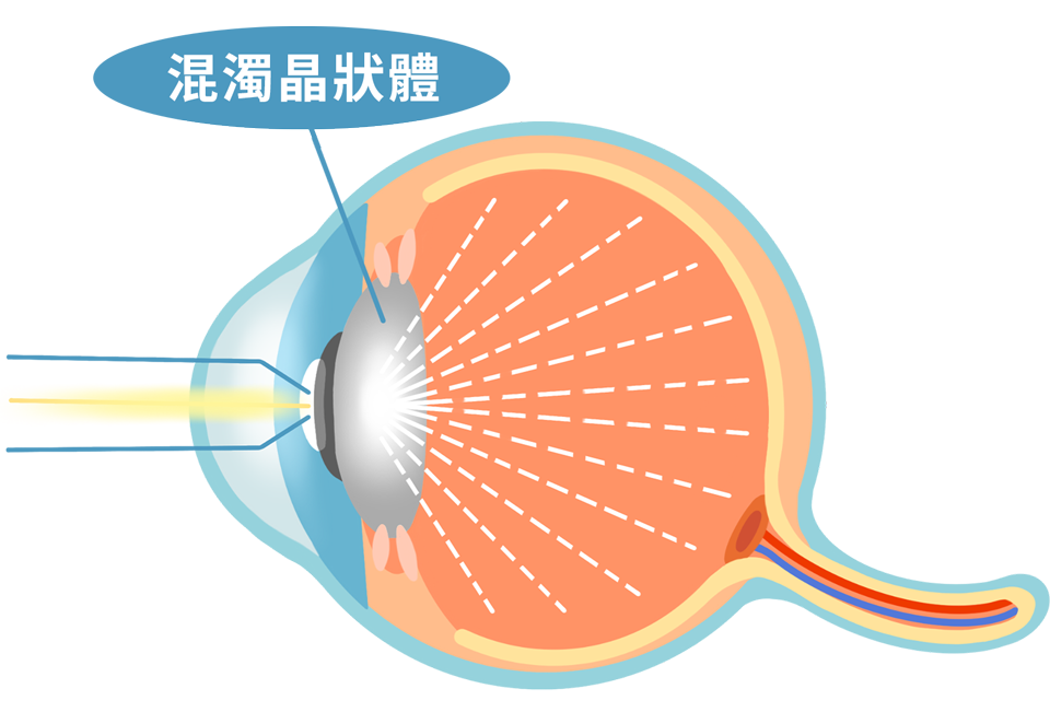 cataract_test