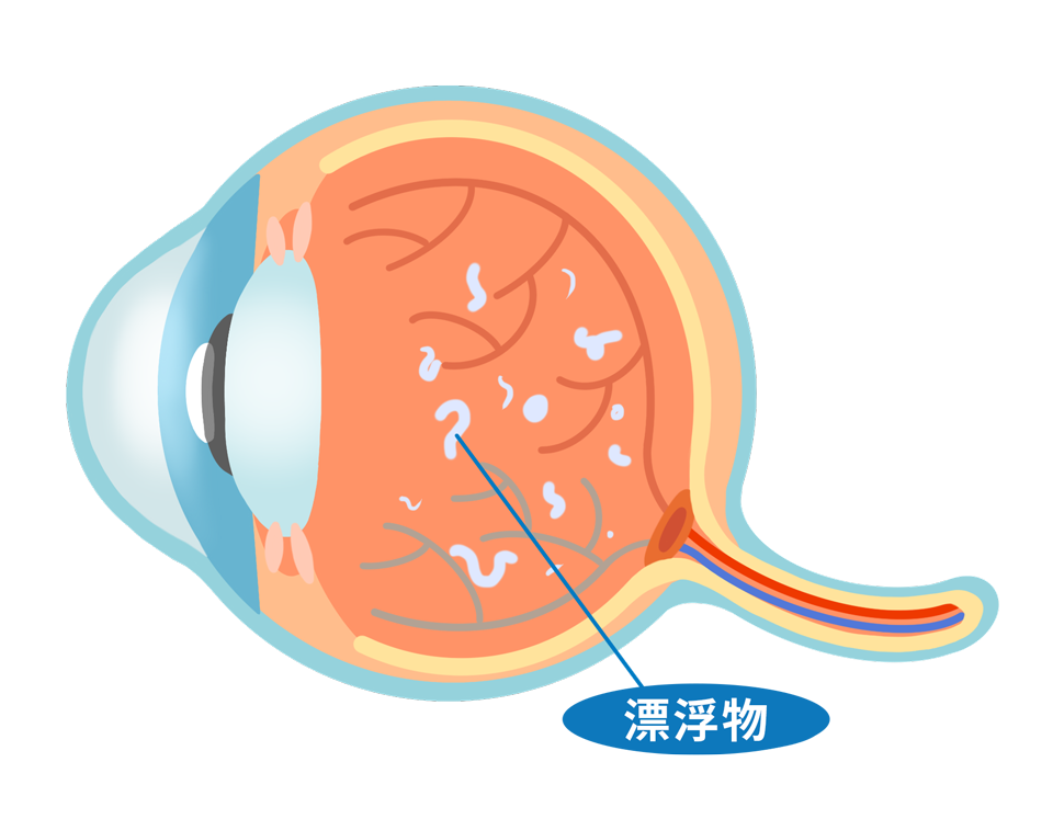 ecd_floaters_type