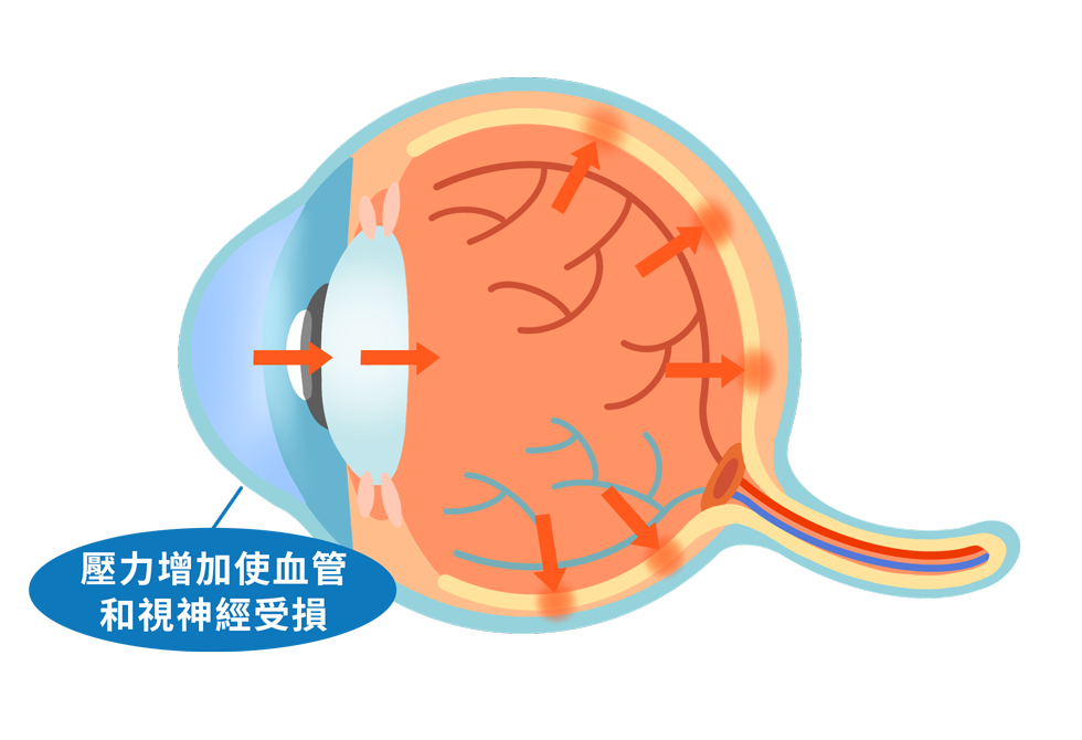 ecd_glaucoma_know