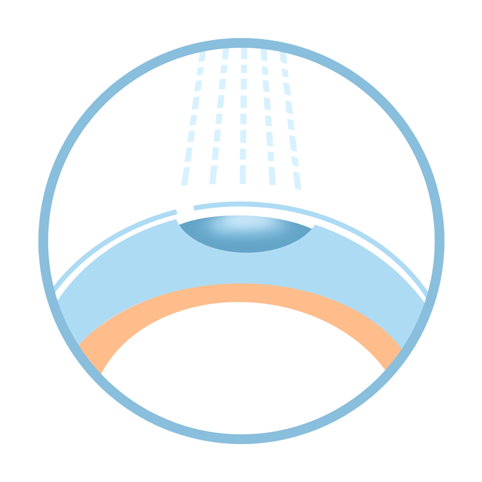 lasik_smile_compare
