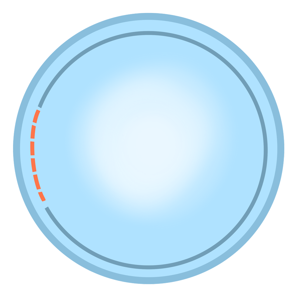 lasik_smile_compare