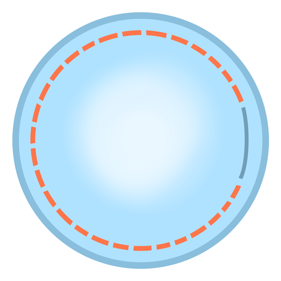 lasik_smile_compare