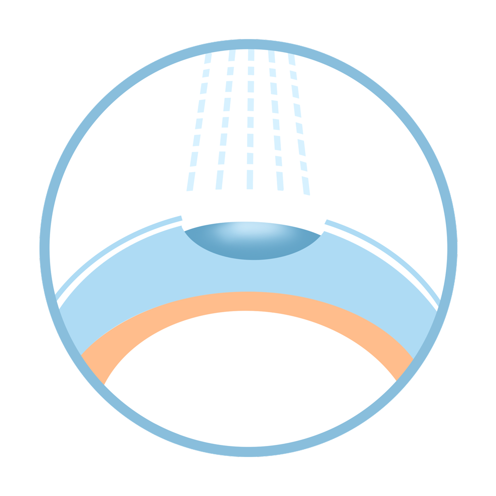 lasik_smile_compare